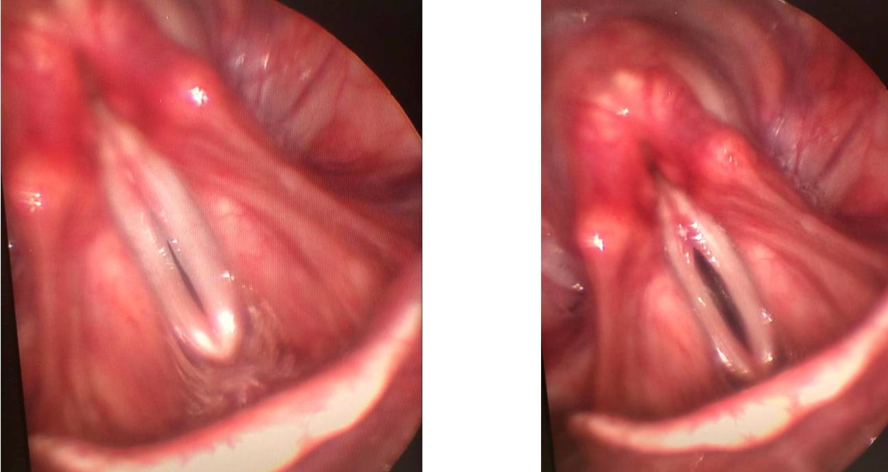 A high-resolution image of vocal folds on motion using laryngeal endoscopy procedure